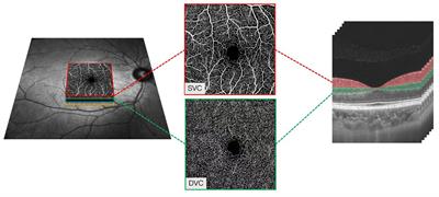 Retinal microvasculature and imaging markers of brain frailty in normal aging adults